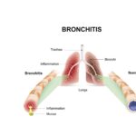 Bronchitis VCare VCare Urgent Care | Primary Care South Brunswick Dayton NJ