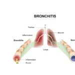 Bronchitis-VCare